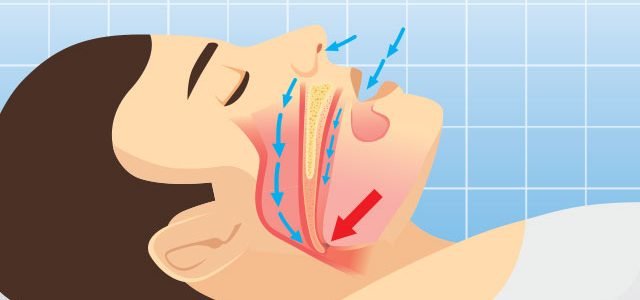 What Is Obstructive Sleep Apnoea?